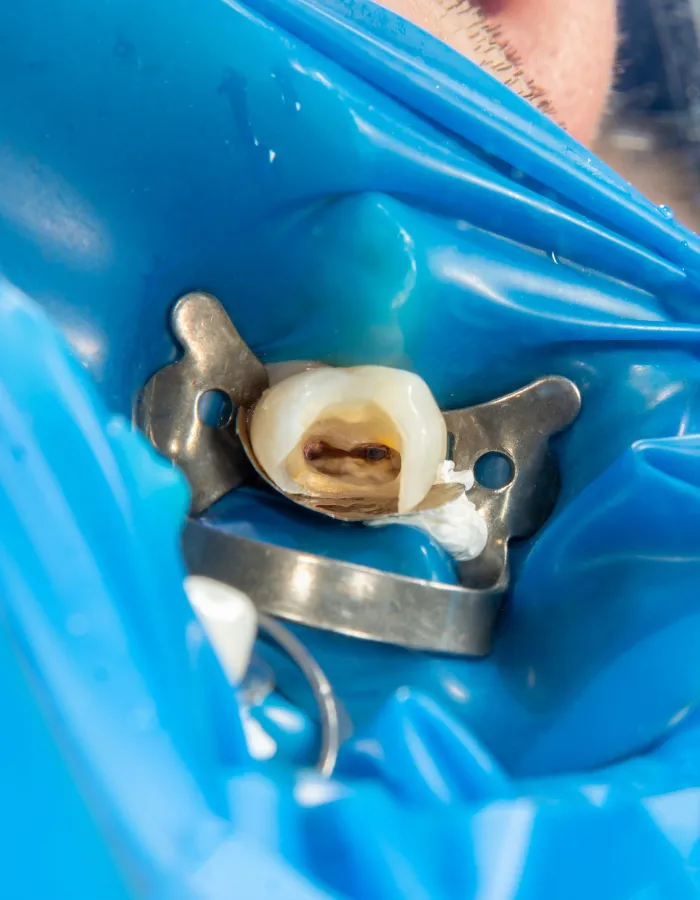 root canal in islamabad