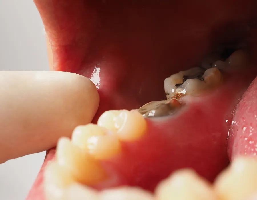 root canal in islamabad