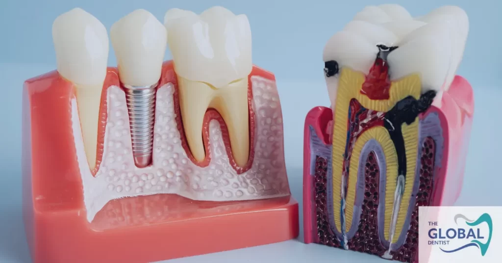 Best Dental Implants in Islamabad