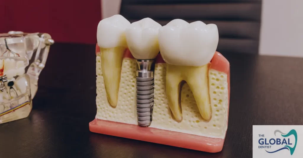 Implant-Supported Crowns in Islamabad