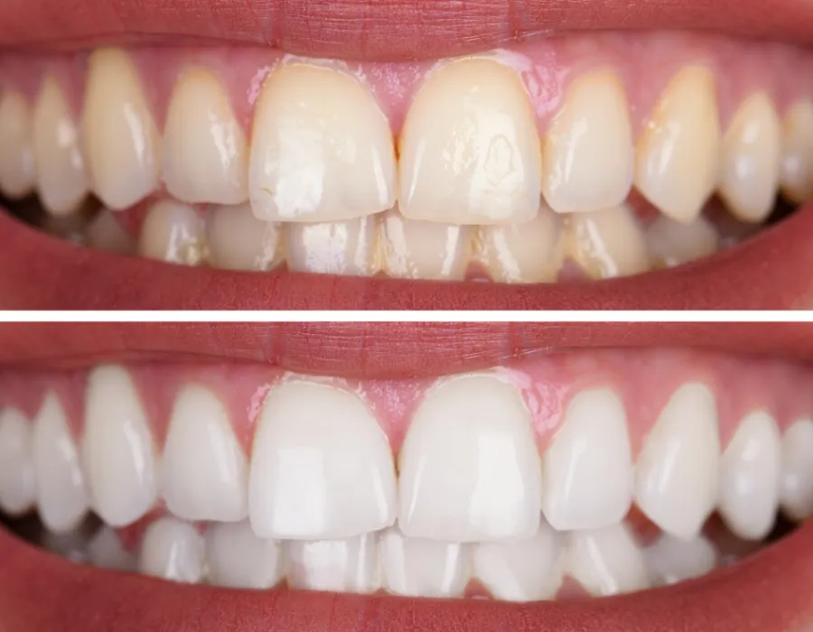 Teeth whitening procedure