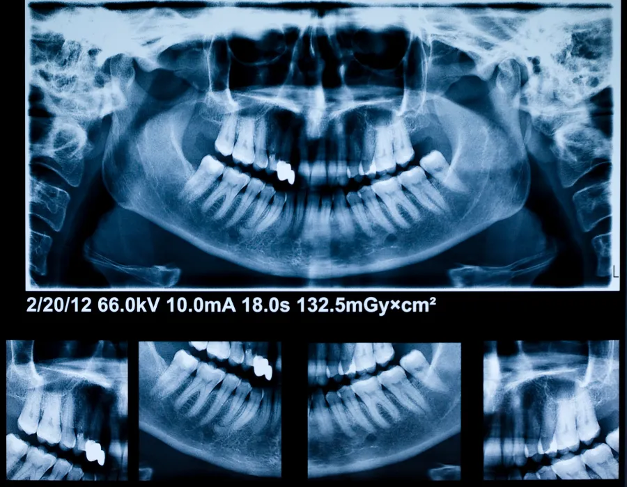 Advanced Dental X-Rays in Islamabad