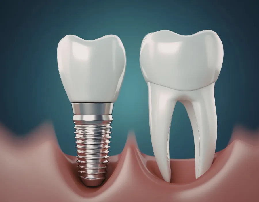 Braces & Dental Implants in Islamabad