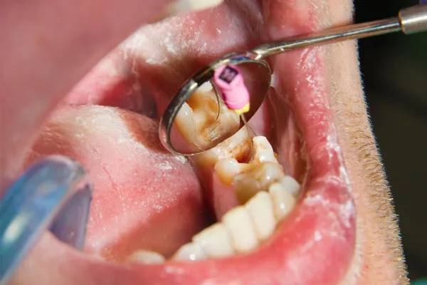 Root Canal Treatment