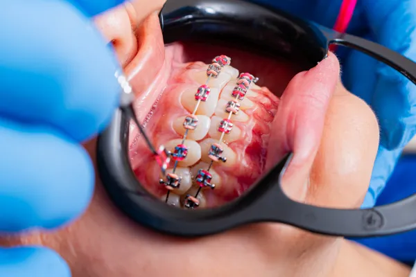 Braces & Dental Implants