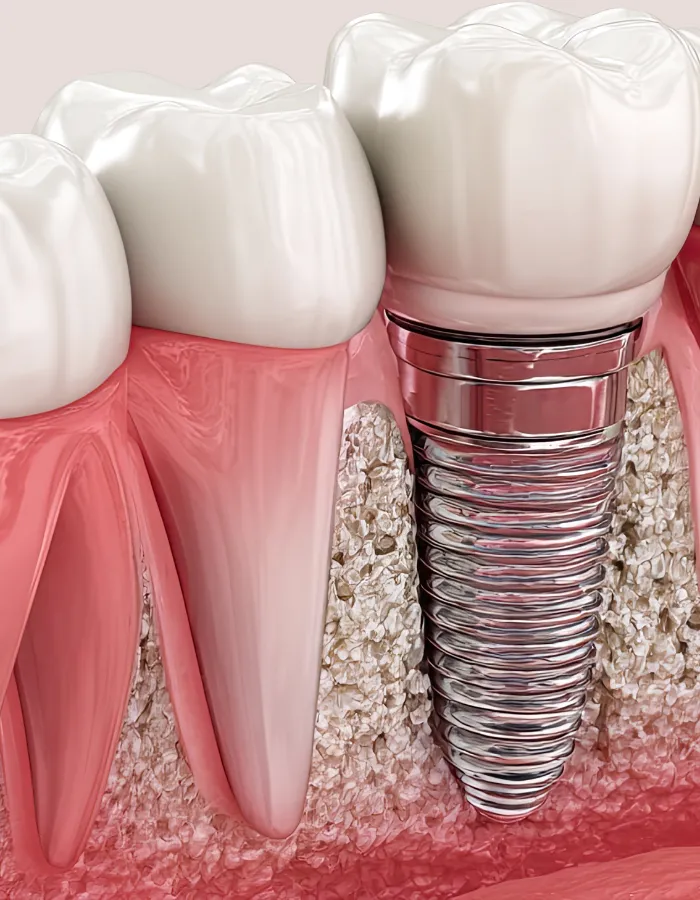 Dental implant in islamabad