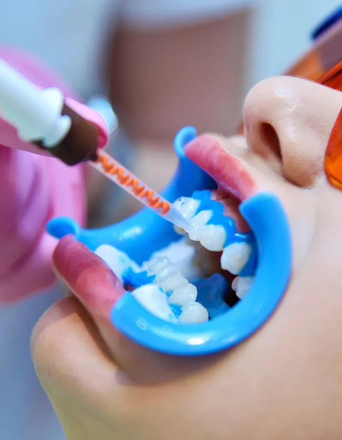 Teeth whitening procedure